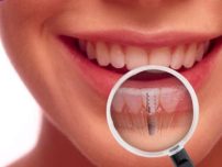 Tratamente cu implant dentar revolutionare!